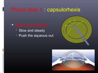 Phaco step 1 : capsulorhexis
 Inject viscoelastic
 Slow and steady
 Push the aqueous out

 