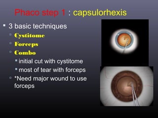 Phaco step 1 : capsulorhexis
 3 basic techniques
 Cystitome
 Forceps
 Combo

 initial cut with cystitome
 most of tear with forceps
 *Need major wound to use

forceps

 