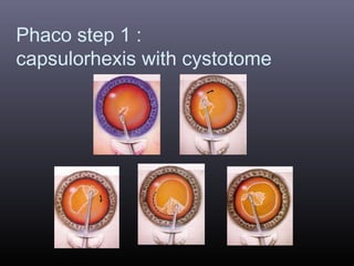 Phaco step 1 :
capsulorhexis with cystotome

 