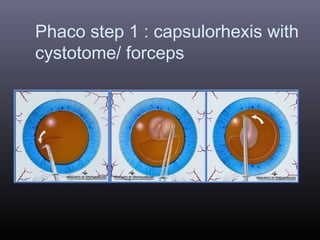 Phaco step 1 : capsulorhexis with
cystotome/ forceps

 