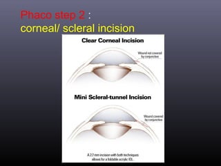 Phaco step 2 :
corneal/ scleral incision

 