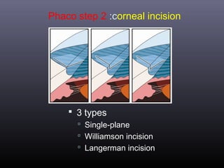 Phaco step 2 :corneal incision

 3 types
 Single-plane
 Williamson incision
 Langerman incision

 