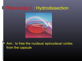 Phaco step 3 : Hydrodissection

 Aim : to free the nucleus/ epinucleus/ cortex

from the capsule

 