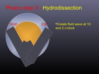Phaco step 3 : Hydrodissection
10:00

2:00

Create fluid wave at 10

and 2 o’clock

 