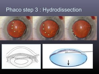 Phaco step 3 : Hydrodissection

 
