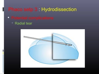 Phaco setp 3 : Hydrodissection
 Potential complications
 Radial tear

 