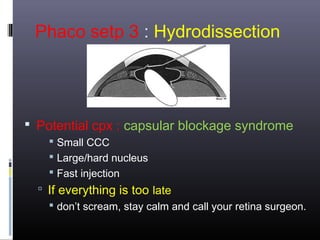 Phaco setp 3 : Hydrodissection

 Potential cpx : capsular blockage syndrome
 Small CCC
 Large/hard nucleus
 Fast injection

 If everything is too late
 don’t scream, stay calm and call your retina surgeon.

 
