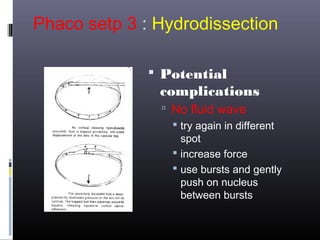 Phaco setp 3 : Hydrodissection
 Potential

complications
 No fluid wave
 try again in different
spot
 increase force
 use bursts and gently
push on nucleus
between bursts

 