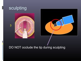 sculpting

3

DO NOT occlude the tip during sculpting

 