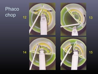 Phaco
chop

12

13

14

15

 