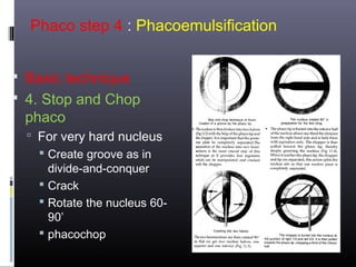 Phaco step 4 : Phacoemulsification
 Basic technique
 4. Stop and Chop

phaco

 For very hard nucleus
 Create groove as in
divide-and-conquer
 Crack

 Rotate the nucleus 6090’
 phacochop

 