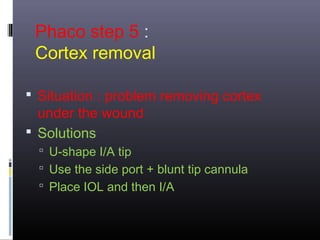 Phaco step 5 :
Cortex removal
 Situation : problem removing cortex

under the wound
 Solutions

 U-shape I/A tip
 Use the side port + blunt tip cannula
 Place IOL and then I/A

 
