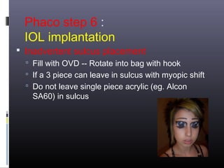 Phaco step 6 :
IOL implantation

 Inadvertent sulcus placement
 Fill with OVD -- Rotate into bag with hook
 If a 3 piece can leave in sulcus with myopic shift
 Do not leave single piece acrylic (eg. Alcon

SA60) in sulcus

 