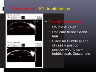 Phaco step 6 : IOL implantation
 Tear in Descemet's
 Double AC sign
 Use care to not extend

tear
 Place Air Bubble at end
of case – post op
position wound up -bubble seals Descemets

 