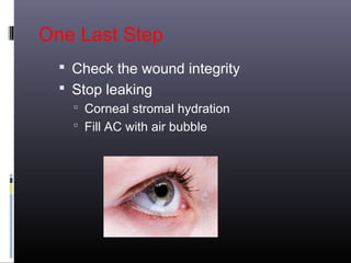 One Last Step
 Check the wound integrity
 Stop leaking
 Corneal stromal hydration
 Fill AC with air bubble

 