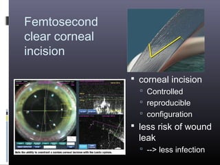 Femtosecond
clear corneal
incision
 corneal incision
 Controlled
 reproducible
 configuration

 less risk of wound

leak

 --> less infection

 