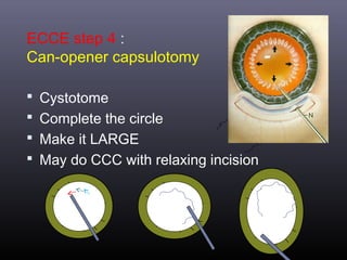 Nw12 Cataract Surgery11