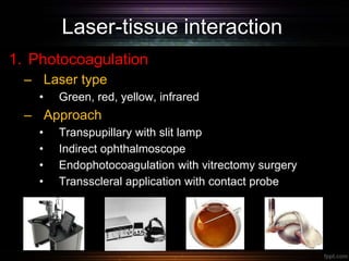 Laser-tissue interaction
1. Photocoagulation
– Laser type
• Green, red, yellow, infrared
– Approach
• Transpupillary with slit lamp
• Indirect ophthalmoscope
• Endophotocoagulation with vitrectomy surgery
• Transscleral application with contact probe
 