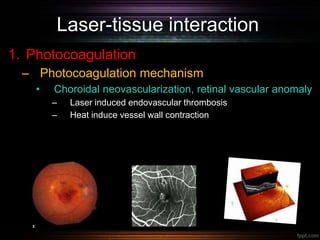 Laser-tissue interaction
1. Photocoagulation
– Photocoagulation mechanism
• Choroidal neovascularization, retinal vascular anomaly
– Laser induced endovascular thrombosis
– Heat induce vessel wall contraction
 