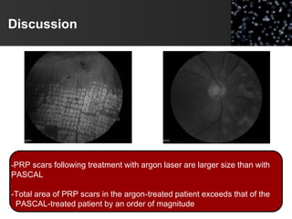 Discussion
-PRP scars following treatment with argon laser are larger size than with
PASCAL
-Total area of PRP scars in the argon-treated patient exceeds that of the
PASCAL-treated patient by an order of magnitude
 