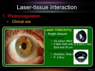 Laser-tissue interaction
1. Photocoagulation
– Clinical use
Laser iridectomy
• Angle closure
• Argon laser
• Iris colour effect
• P.800-1000 mW, D 0.02-0.1 sec,
Spot size 50 µm
• Q-switch Nd:YAG laser
• Abraham, Wise lens
• P. 2-8mJ
 