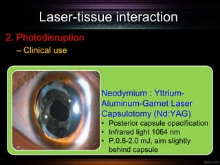 Laser-tissue interaction
2. Photodisruption
– Clinical use
Neodymium : Yttrium-
Aluminum-Garnet Laser
Capsulotomy (Nd:YAG)
• Posterior capsule opacification
• Infrared light 1064 nm
• P.0.8-2.0 mJ, aim slightly
behind capsule
 