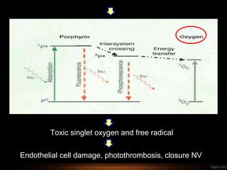 Toxic singlet oxygen and free radical
Endothelial cell damage, photothrombosis, closure NV
 