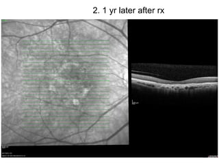 103
2. 1 yr later after rx
 