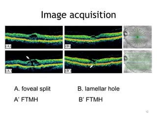 Image acquisition
A. foveal split B. lamellar hole
A’ FTMH B’ FTMH
12
 