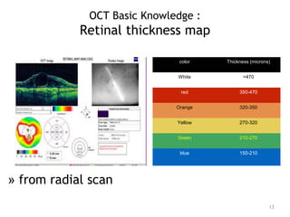 OCT Basic Knowledge :
Retinal thickness map
13
color Thickness (microns)
White >470
red 350-470
Orange 320-350
Yellow 270-320
Green 210-270
blue 150-210
» from radial scan
 