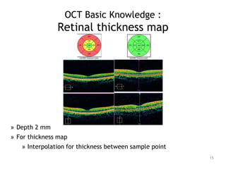 OCT Basic Knowledge :
Retinal thickness map
15
» Depth 2 mm
» For thickness map
» Interpolation for thickness between sample point
 