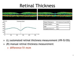 Retinal Thickness
» (L) automated retinal thickness measurement (VR-IS/OS)
» (R) manual retinal thickness measurement
» difference 51 mcm
19
 