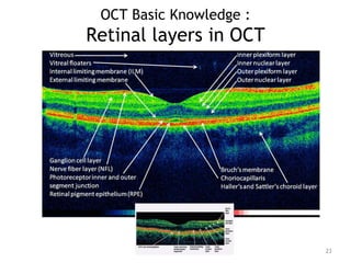 OCT Basic Knowledge :
Retinal layers in OCT
23
 