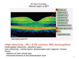 »High reflectivity : NFL/ IS-OS Junction/ RPE-choriocapillaris
»Intermediate reflectivity : plexiform layers
»Low reflectivity : nuclear layers/ photoreceptor outer segment/ vitreous
»Fovea
»Absence of inner retinal layer
»Increased thickness of the photoreceptor layer 24
OCT Basic Knowledge :
Retinal layers in OCT
 