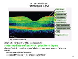 »High reflectivity : NFL/ RPE/ choriocapillatis
»Intermediate reflectivity : plexiform layers
»Low reflectivity : nuclear layers/ photoreceptor outer segment/ vitreous
»Fovea
»Absence of inner retinal layer
»Increased thickness of the photoreceptor layer
25
OCT Basic Knowledge :
Retinal layers in OCT
 