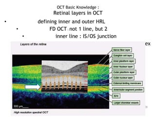 • defining inner and outer HRL
• FD OCT : not 1 line, but 2
• inner line : IS/OS junction
• outer line : RPE choriocapillaris complex
28
OCT Basic Knowledge :
Retinal layers in OCT
 