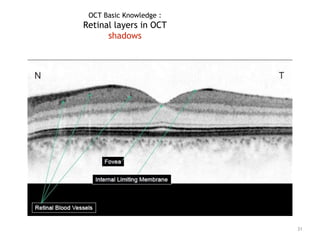 OCT Basic Knowledge :
Retinal layers in OCT
shadows
31
 