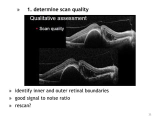 » 1. determine scan quality
» identify inner and outer retinal boundaries
» good signal to noise ratio
» rescan?
35
 