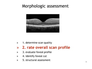 Morphologic assessment
» 1. determine scan quality
» 2. rate overall scan profile
» 3. evaluate foveal profile
» 4. identify foveal cut
» 5. structural assessment
36
 