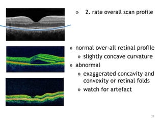 » 2. rate overall scan profile
» normal over-all retinal profile
» slightly concave curvature
» abnormal
» exaggerated concavity and
convexity or retinal folds
» watch for artefact
37
 