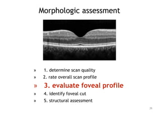 Morphologic assessment
» 1. determine scan quality
» 2. rate overall scan profile
» 3. evaluate foveal profile
» 4. identify foveal cut
» 5. structural assessment
39
 