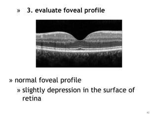 » 3. evaluate foveal profile
» normal foveal profile
» slightly depression in the surface of
retina
40
 