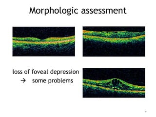 Morphologic assessment
loss of foveal depression
 some problems
41
 