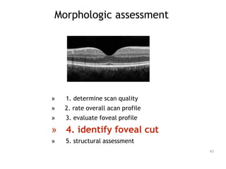 Morphologic assessment
» 1. determine scan quality
» 2. rate overall acan profile
» 3. evaluate foveal profile
» 4. identify foveal cut
» 5. structural assessment
43
 