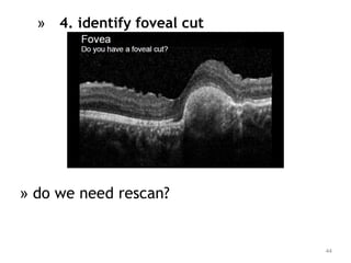 » 4. identify foveal cut
» do we need rescan?
44
 