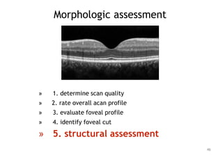 Morphologic assessment
» 1. determine scan quality
» 2. rate overall acan profile
» 3. evaluate foveal profile
» 4. identify foveal cut
» 5. structural assessment
46
 