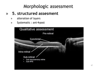 Morphologic assessment
» 5. structured assesment
» alteration of layers
» Systematic : antpost
47
 