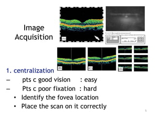 Image
Acquisition
1. centralization
– pts c good vision : easy
– Pts c poor fixation : hard
• Identify the fovea location
• Place the scan on it correctly 5
 