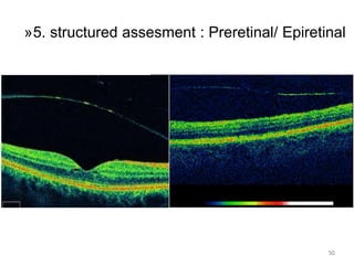 50
»5. structured assesment : Preretinal/ Epiretinal
 