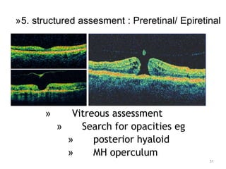 » Vitreous assessment
» Search for opacities eg
» posterior hyaloid
» MH operculum
51
»5. structured assesment : Preretinal/ Epiretinal
 